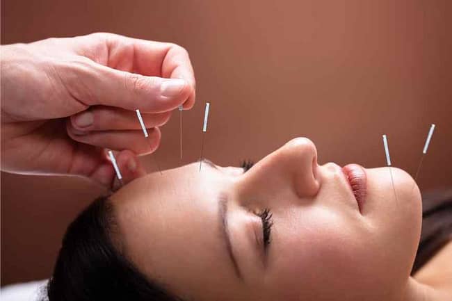 Acupuncture for a natural cure for headache