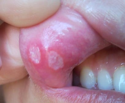 Canker-Sore_17_inside-lip (1) home remedies for canker sores