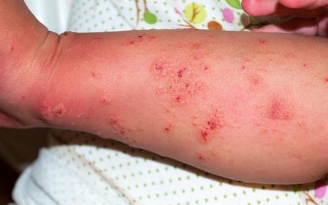 natural remedies for scabies image of a rash