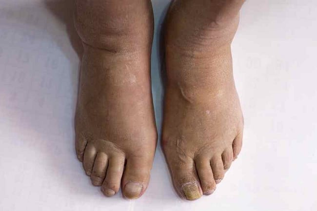 swollen foot home remedies