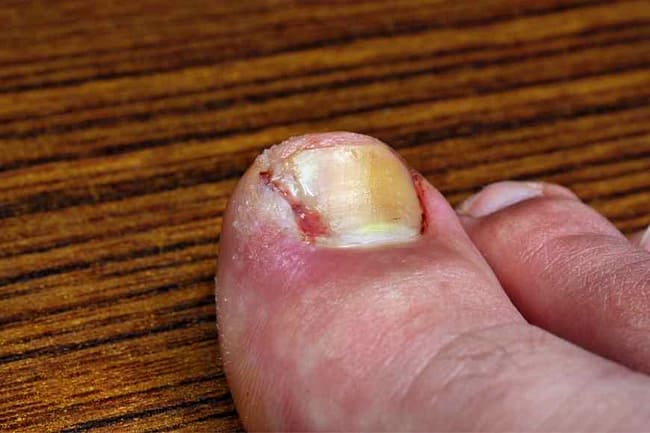 home remedies for ingrown nails