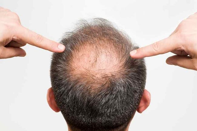 male pattern baldness home remedies
