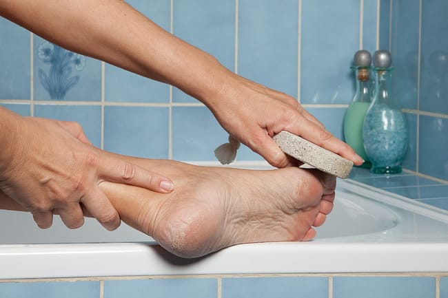 natural remedies for calluses using a pumice stone on the foot
