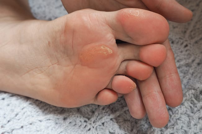 home remedies for calluses on feet