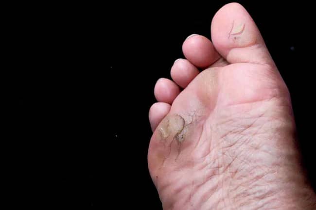how to get rid of foot fungus naturally 