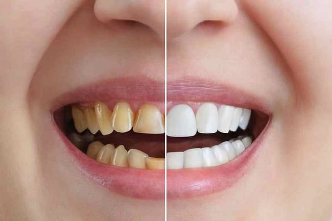 natural remedies for yellow teeth