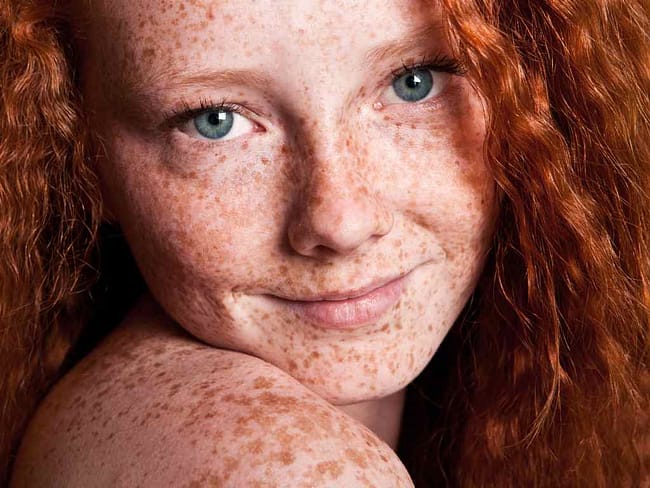 how to get rid of freckles naturally