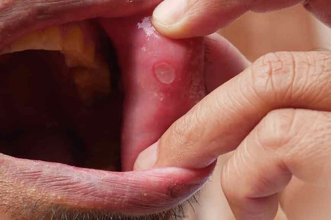 home treatment for mouth ulcers